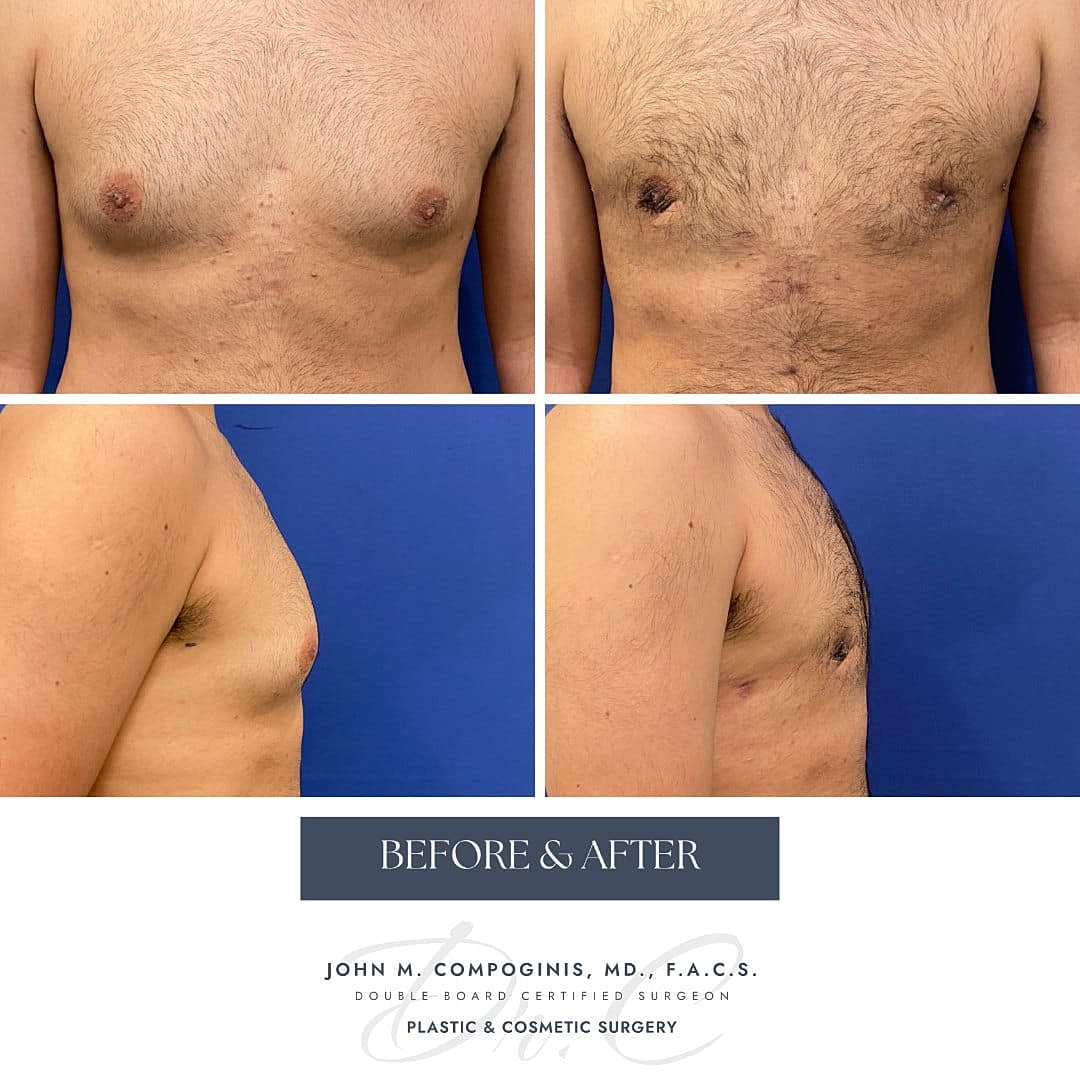 Gynecomastia Before & After