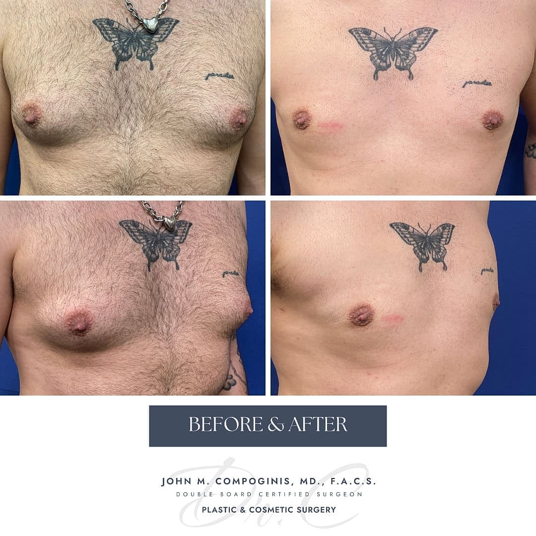 Gynecomastia Before & After