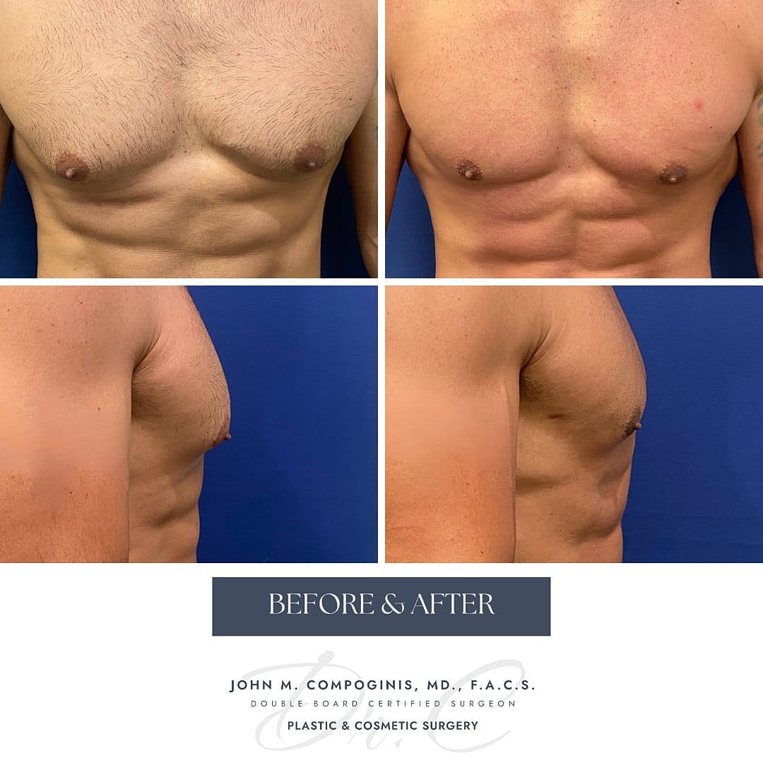 Gynecomastia Before & After