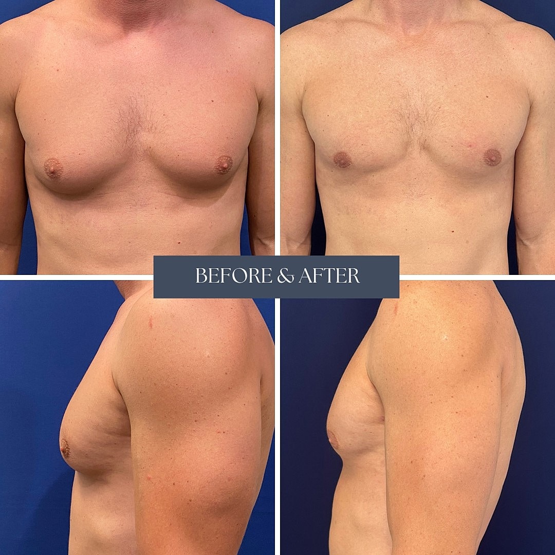Male chest transformation before and after surgery.