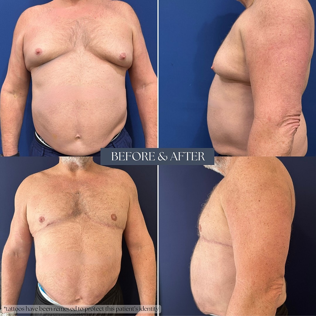 Male body transformation before and after surgery.
