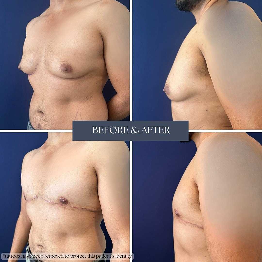Before and after chest transformation results