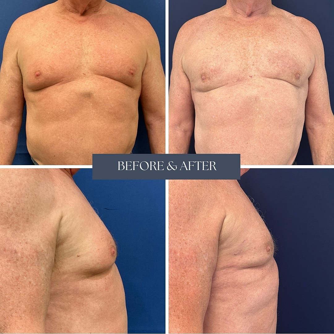 Men's chest transformation: before and after photos.