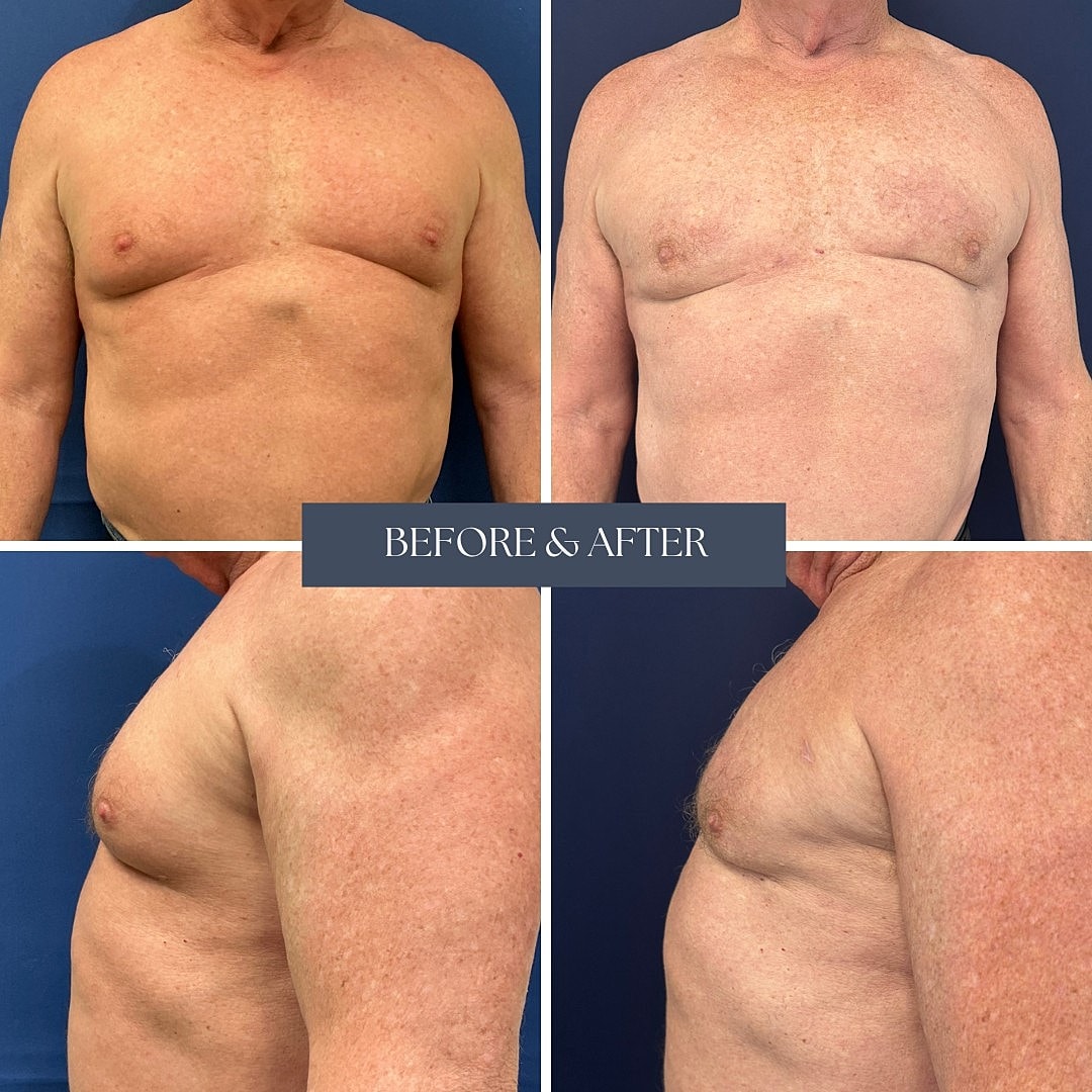 Chest transformation before and after procedure.