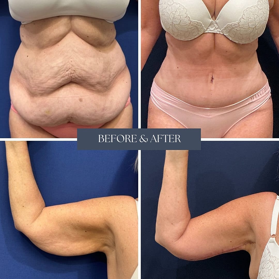 Mommy Makeover Before & After