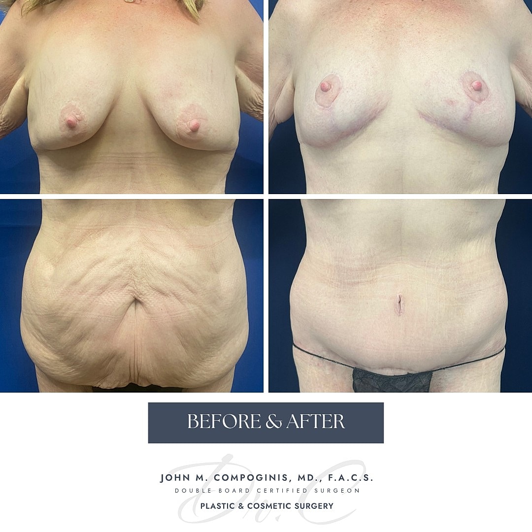 Before and after cosmetic surgery results.