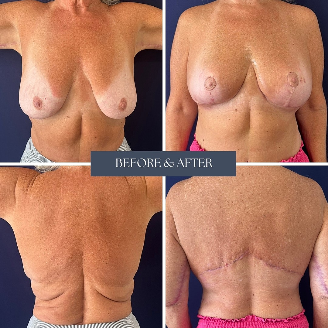 Breast surgery before and after results.