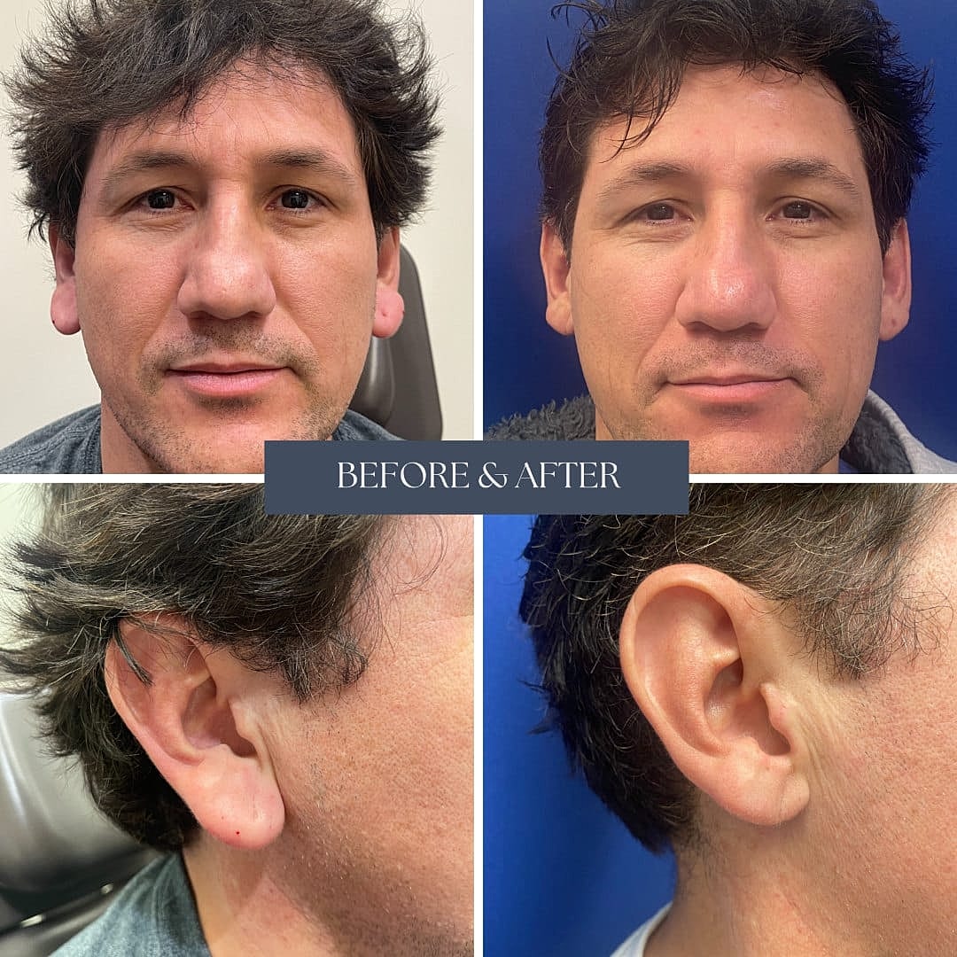 Procedimientos En Las Orejas Before & After