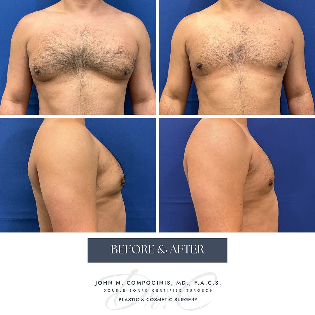 Ginecomastia Before & After