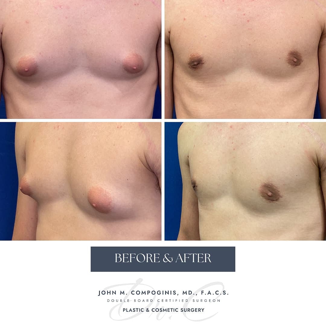 Ginecomastia Before & After