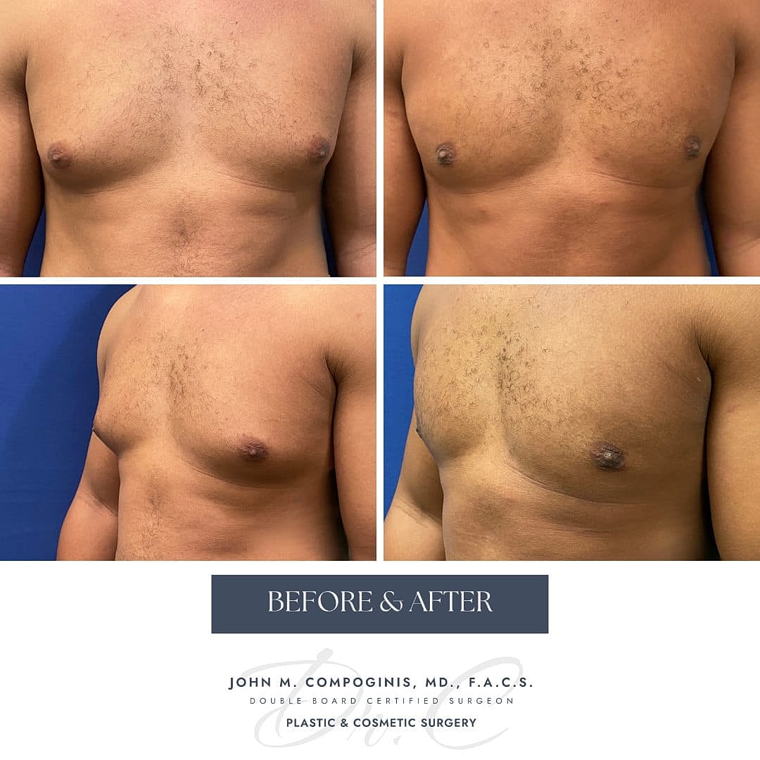 Ginecomastia Before & After