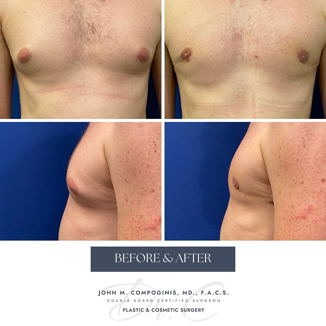 Ginecomastia Before & After