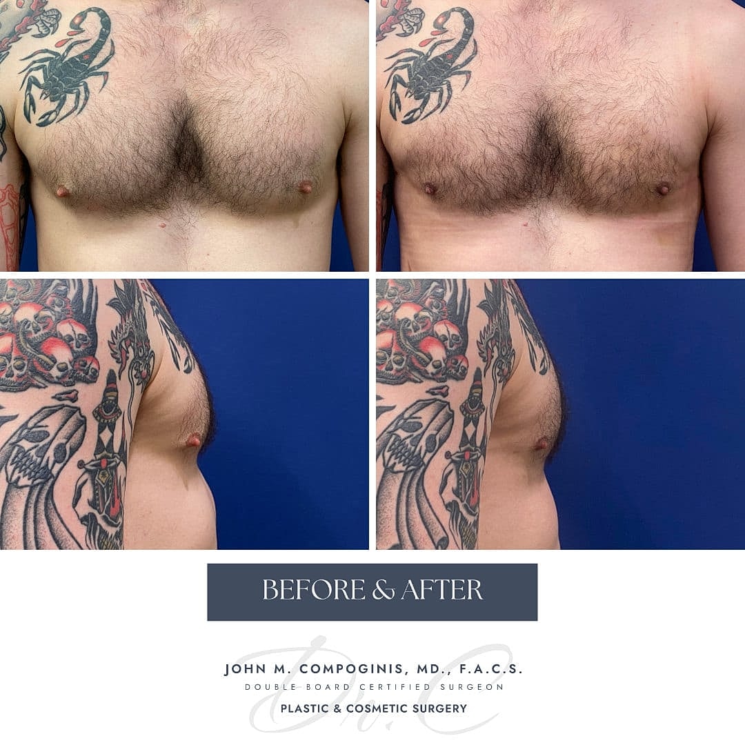 Ginecomastia Before & After