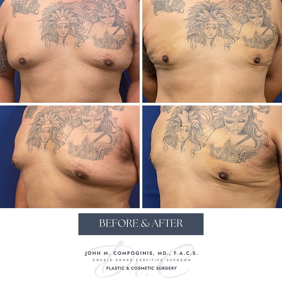 Ginecomastia Before & After