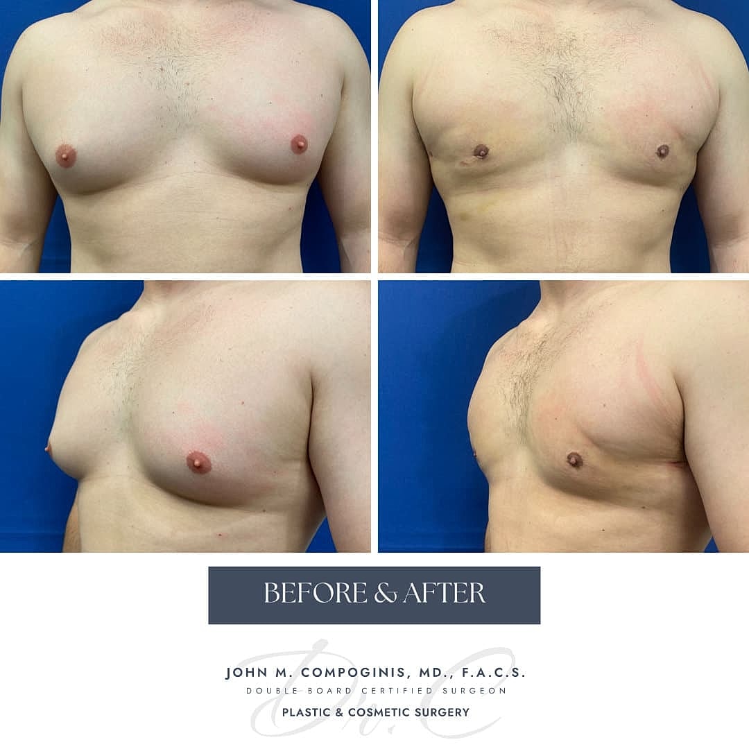 Ginecomastia Before & After