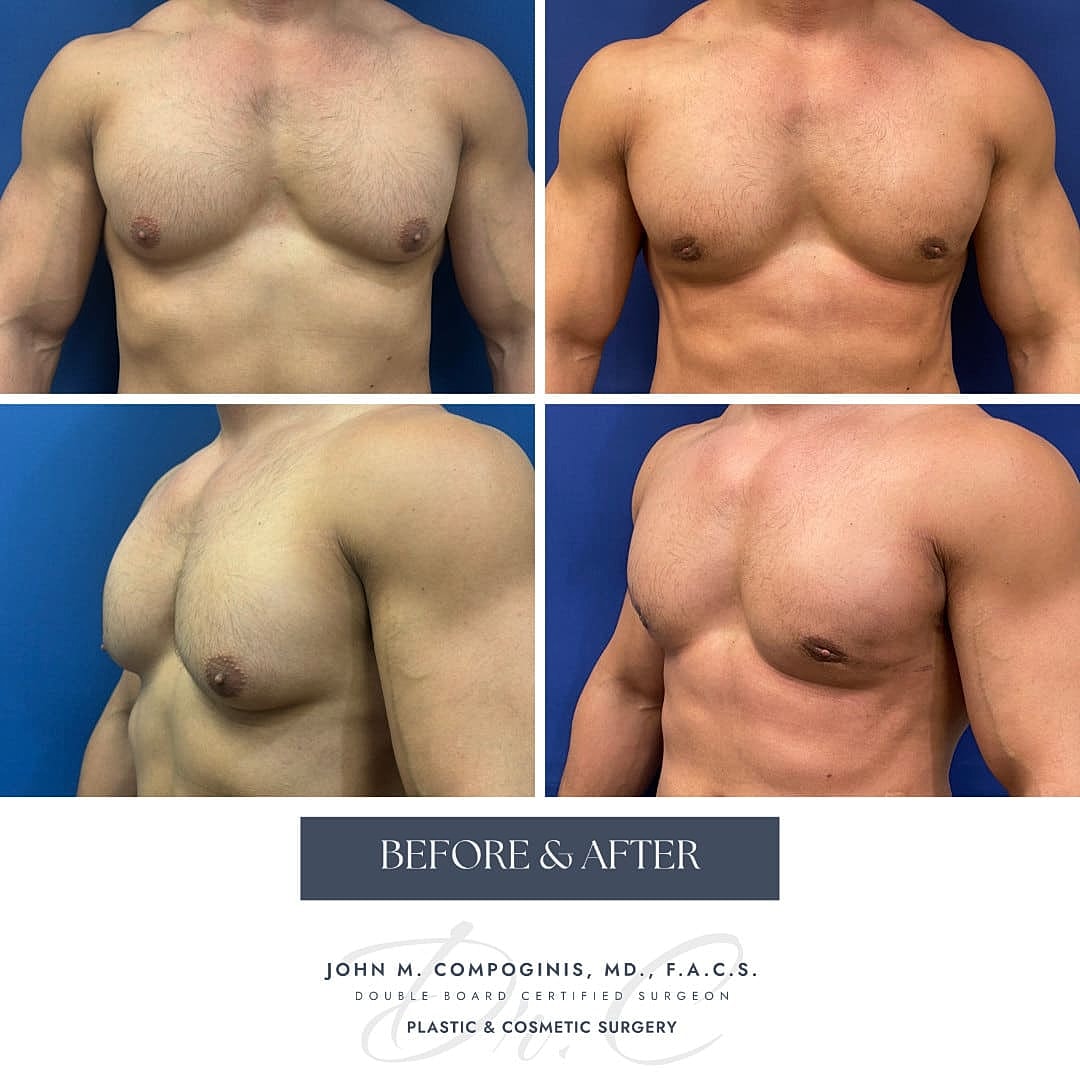 Ginecomastia Before & After