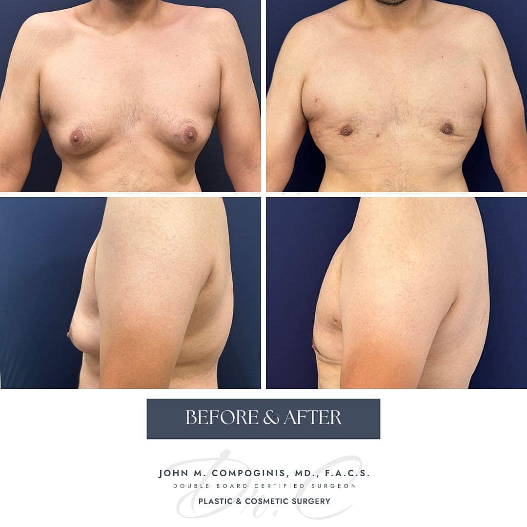 Ginecomastia Before & After