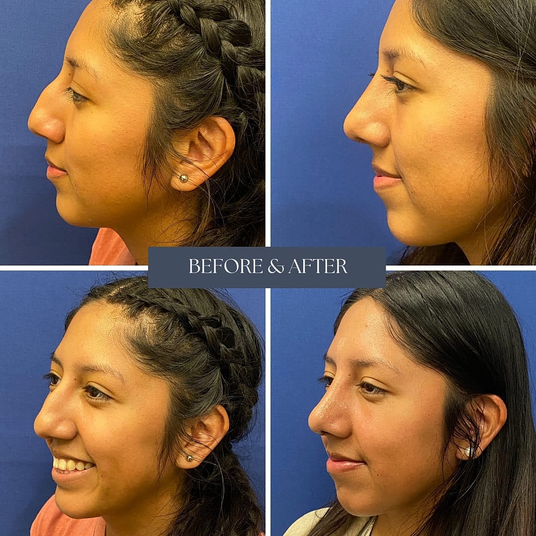 Rhinoplasty Before & After