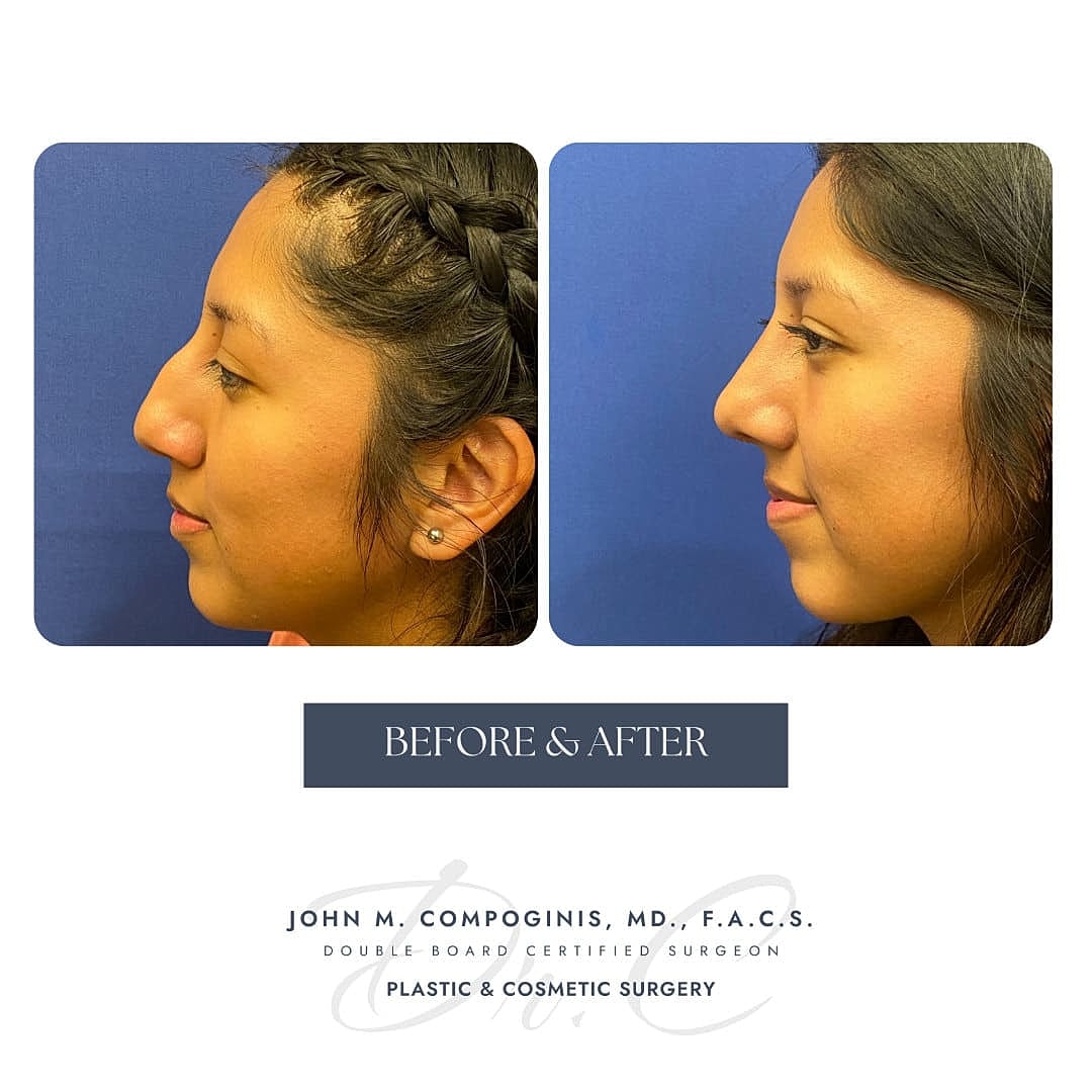 Rhinoplasty Before & After