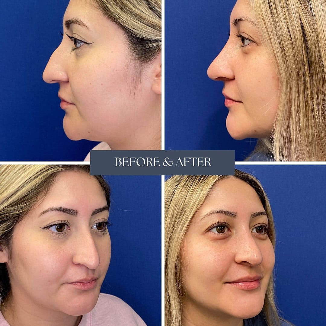 Rhinoplasty Before & After