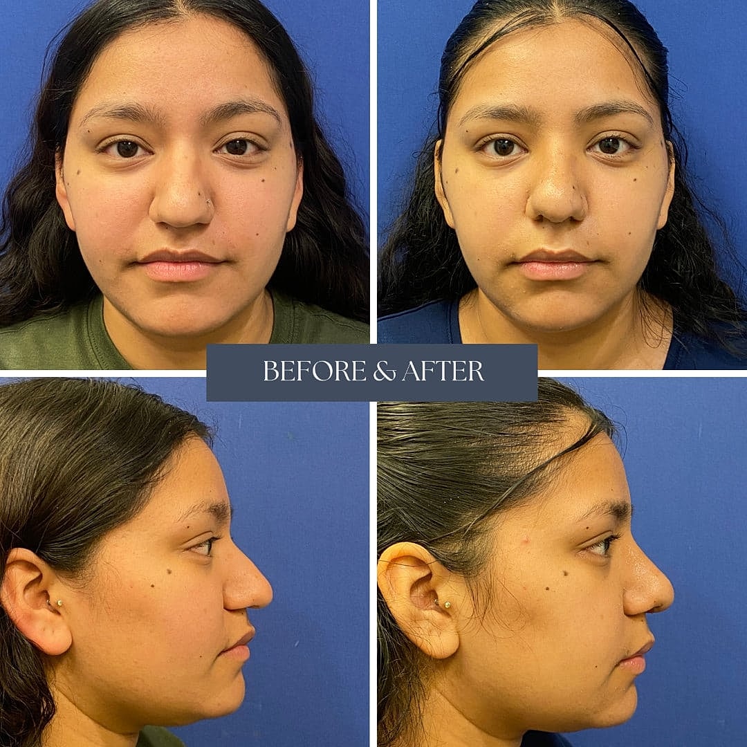 Rhinoplasty Before & After
