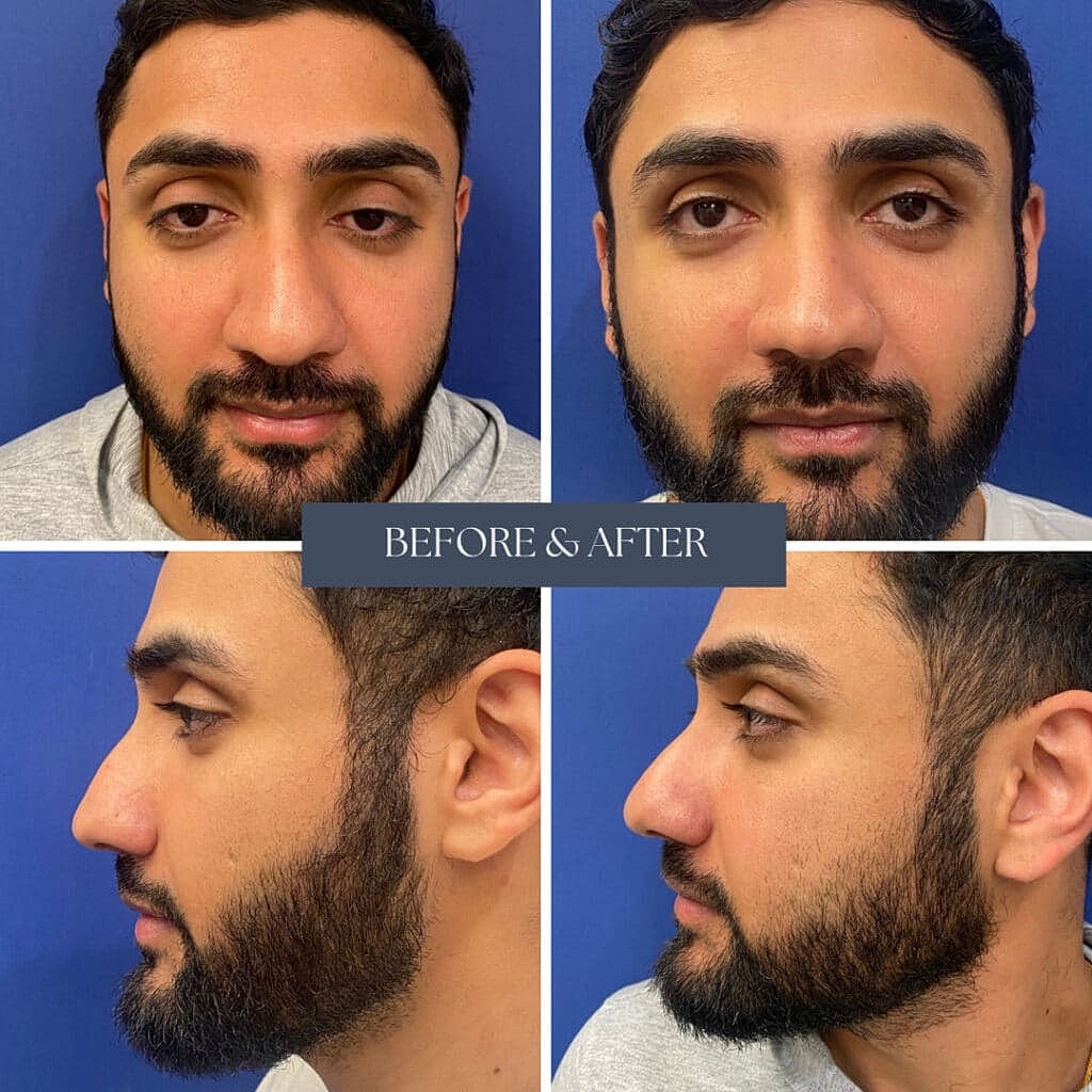 Man's facial transformation before and after surgery