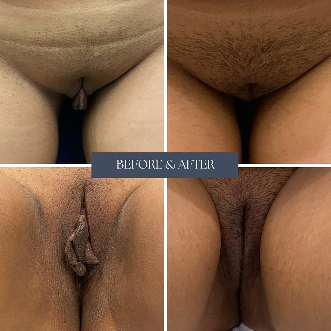 Labiaplasty Before & After