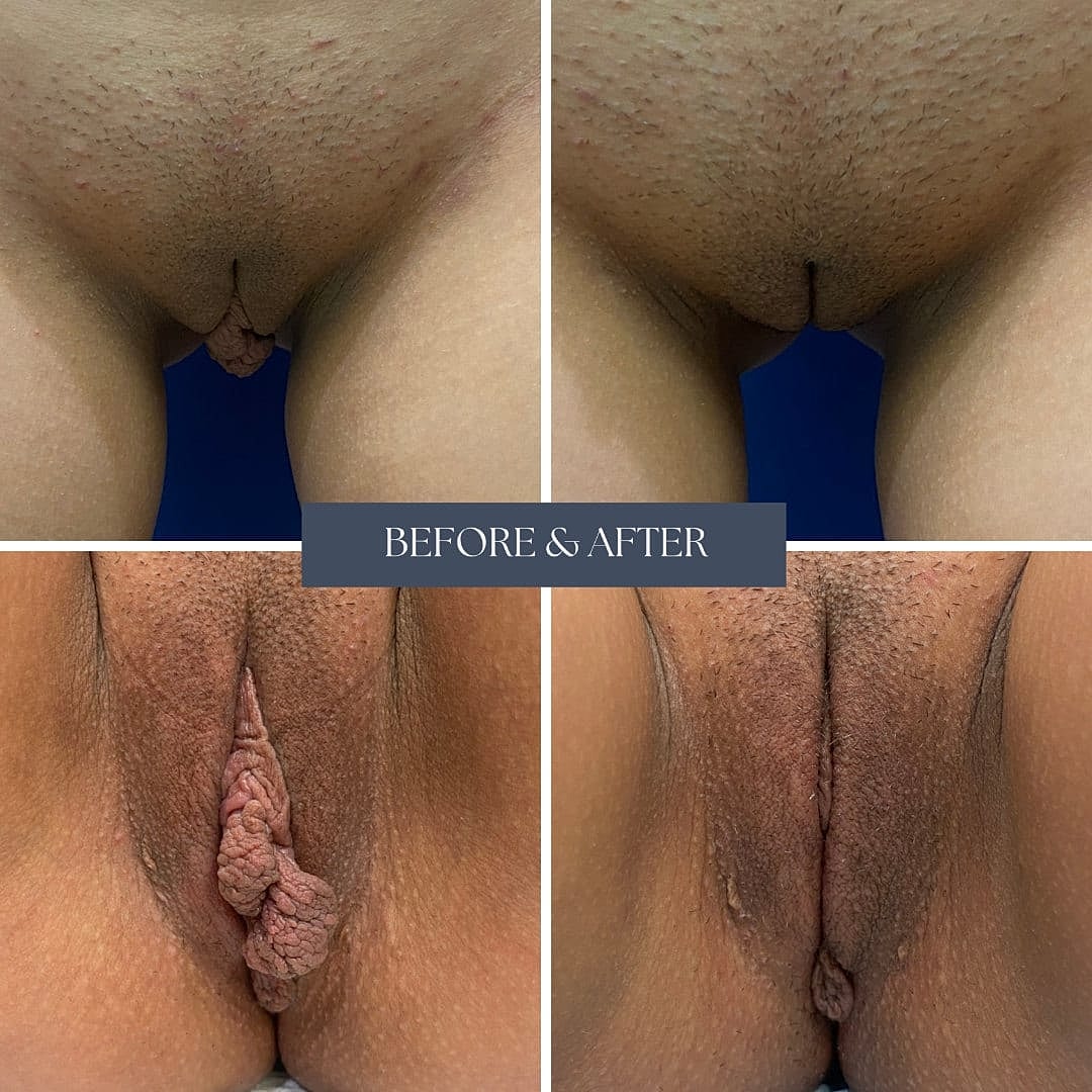 Labiaplasty Before & After