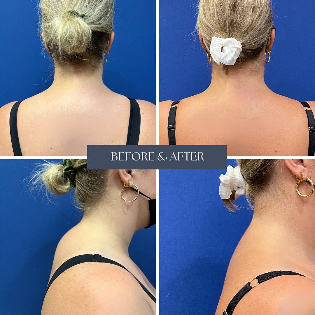 Liposuction Before & After