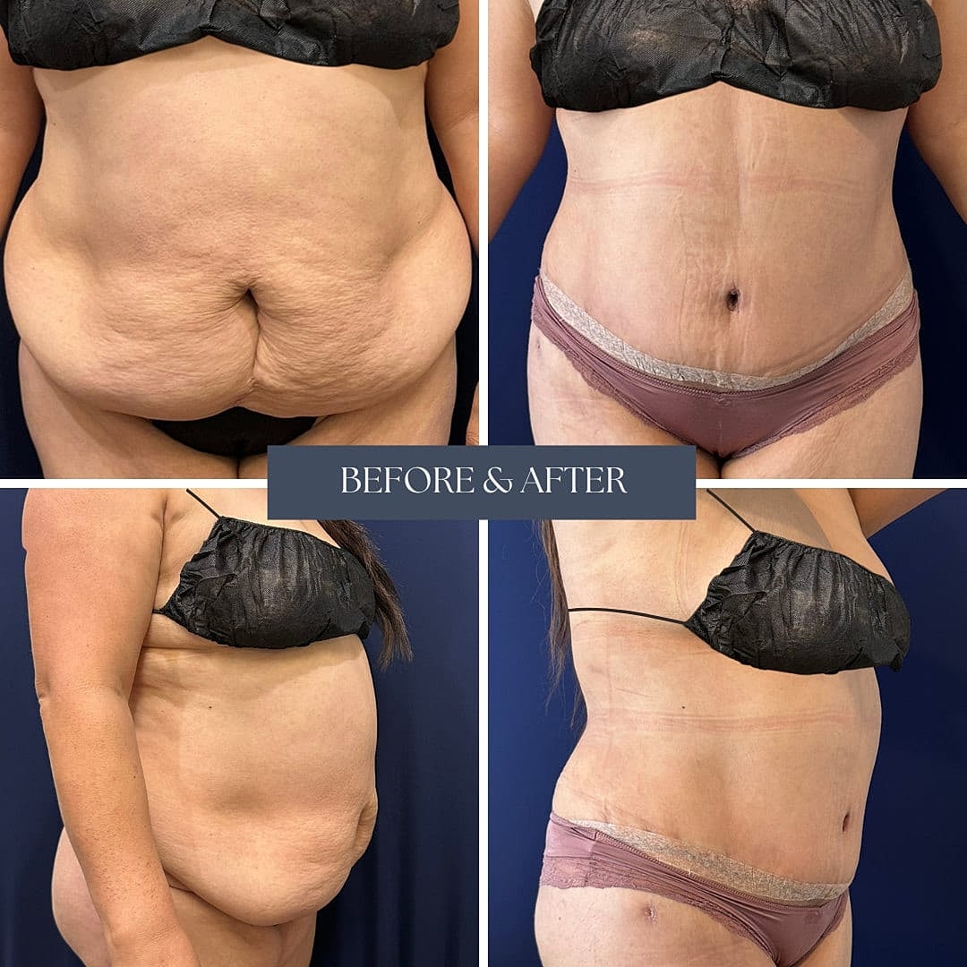 Tummy Tuck Before & After