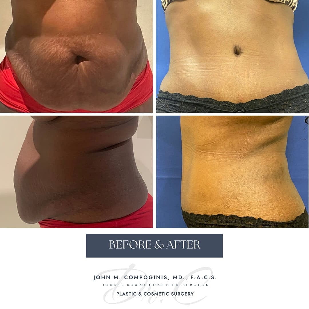 Tummy Tuck Before & After