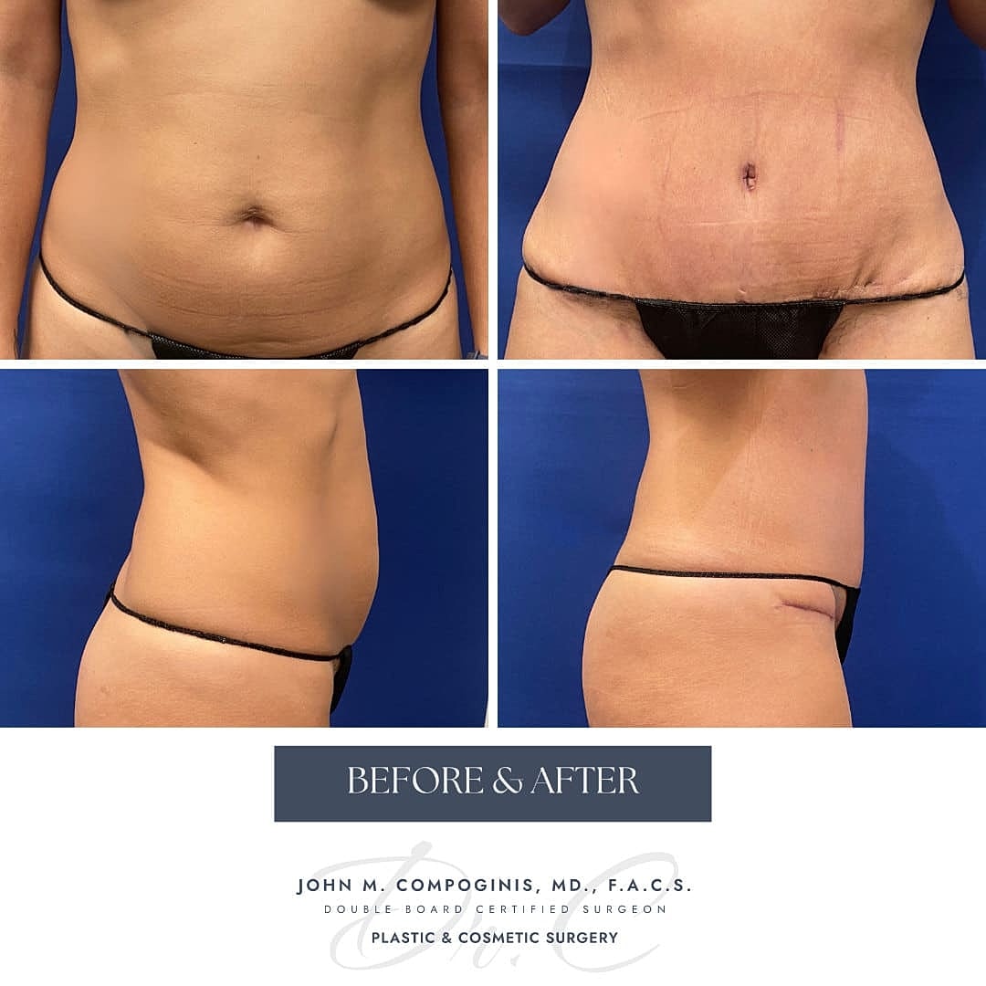 Tummy Tuck Before & After
