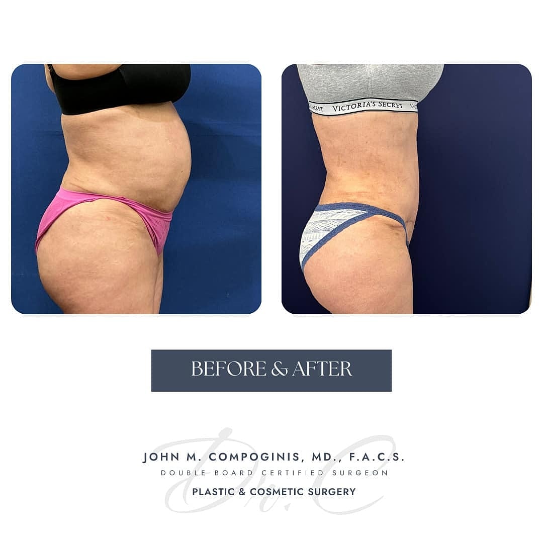 Tummy Tuck Before & After