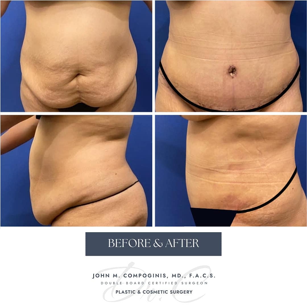 Tummy Tuck Before & After