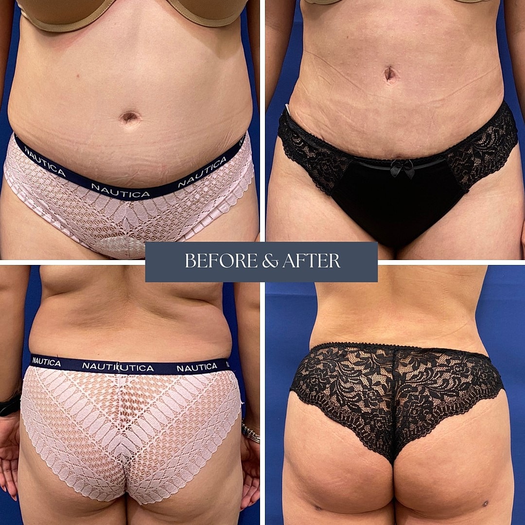 Body transformation before and after in lingerie.