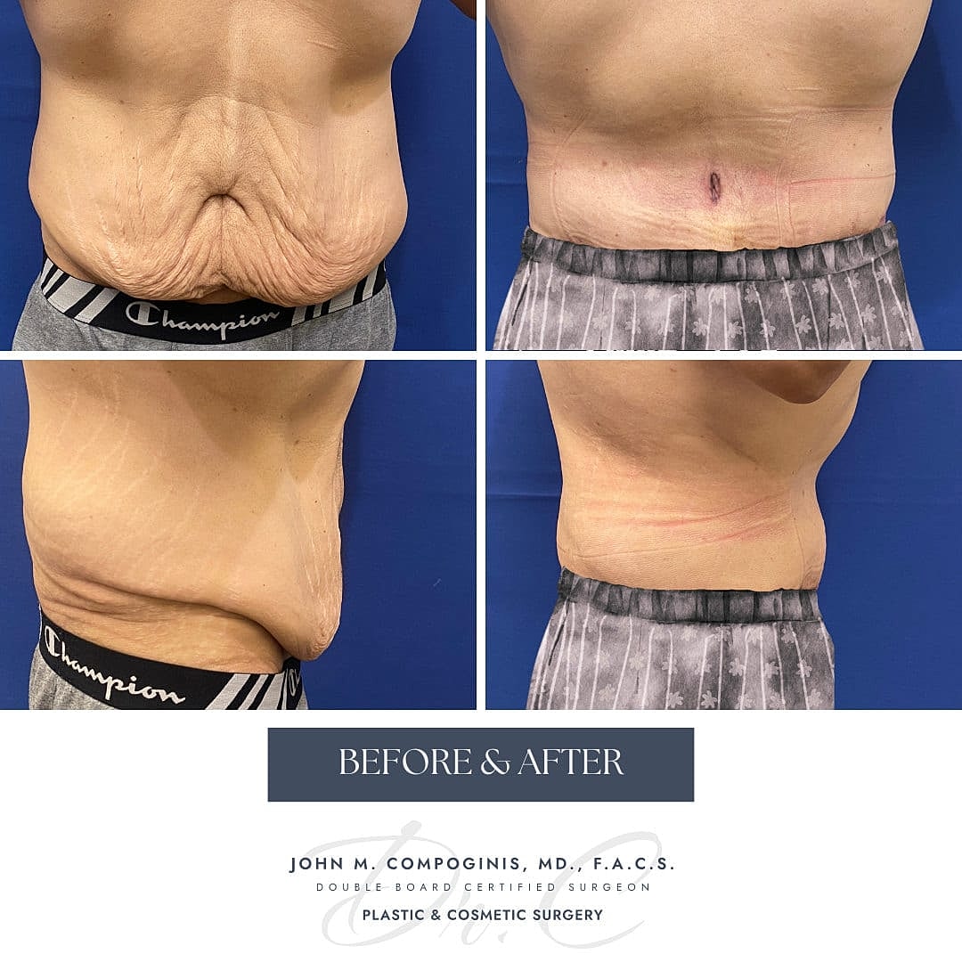 Tummy Tuck Before & After