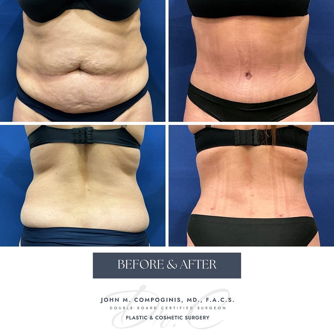 Tummy Tuck Before & After