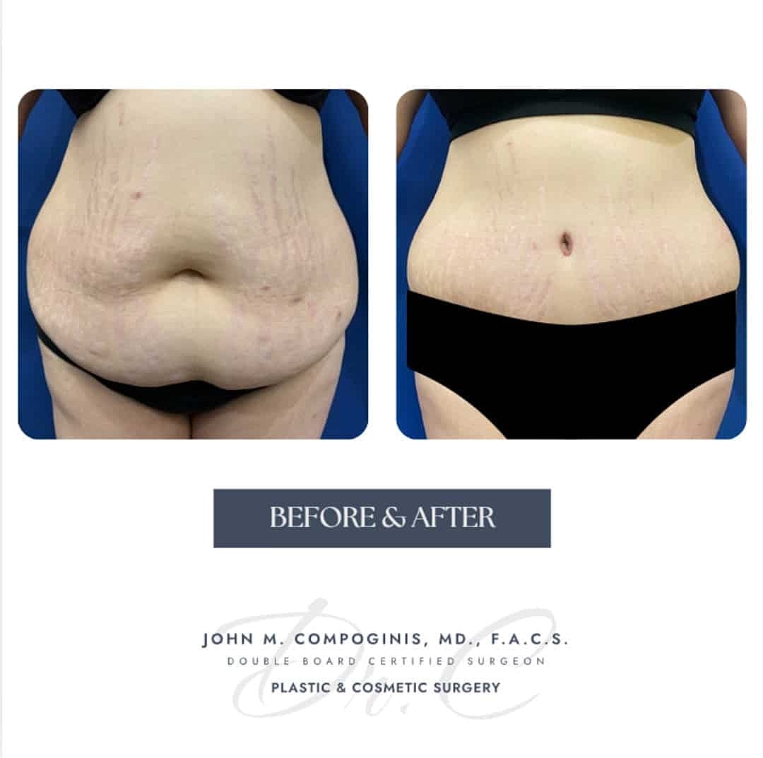 Tummy Tuck Before & After