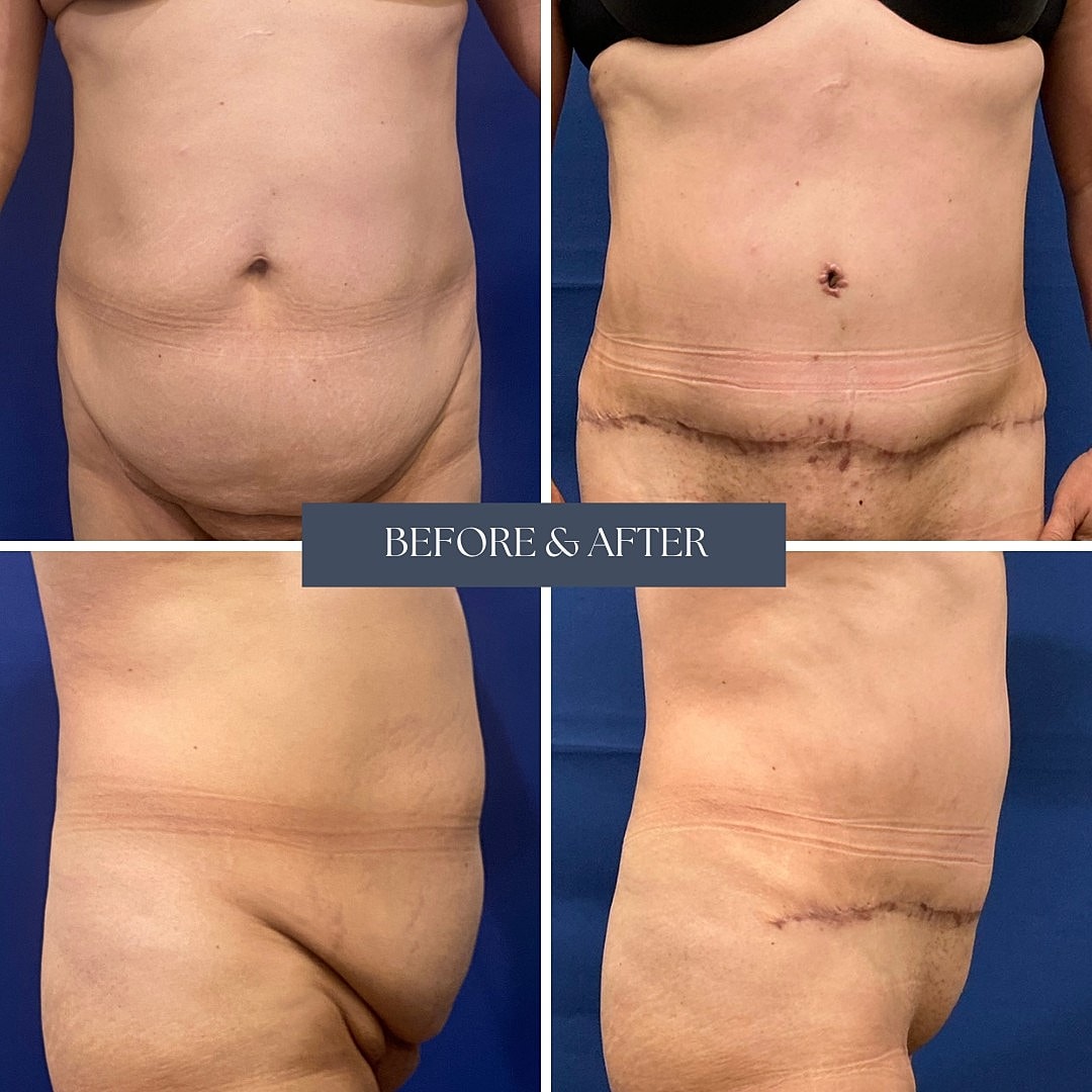 Before and after photos of body transformation.
