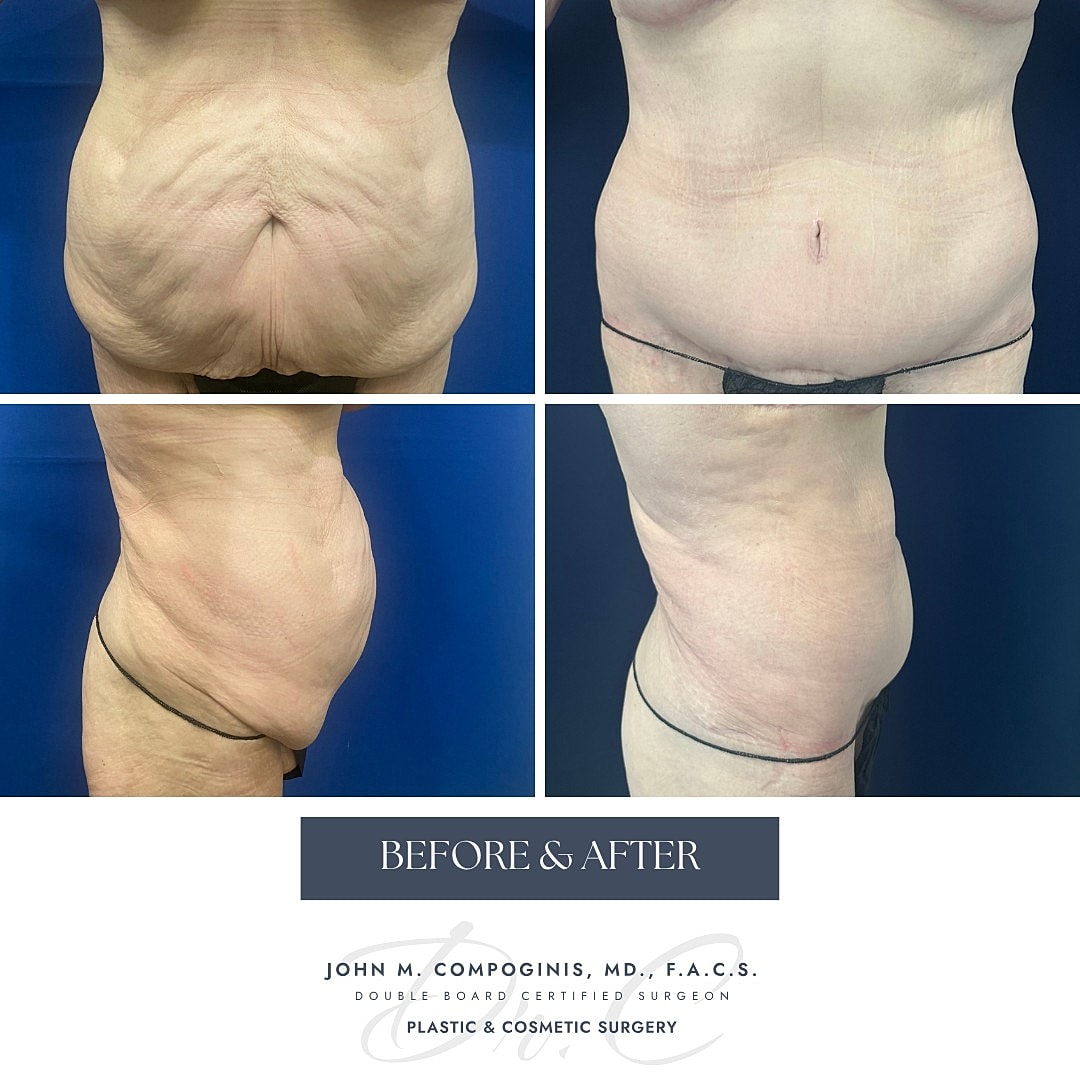 Body transformation before and after cosmetic surgery