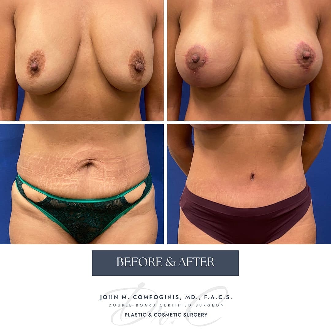 Transformacion Mama Before & After