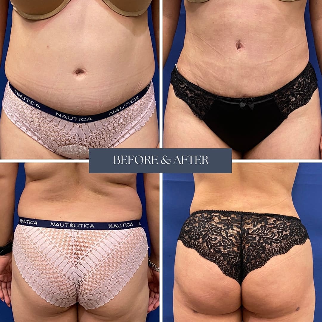 Transformacion Mama Before & After