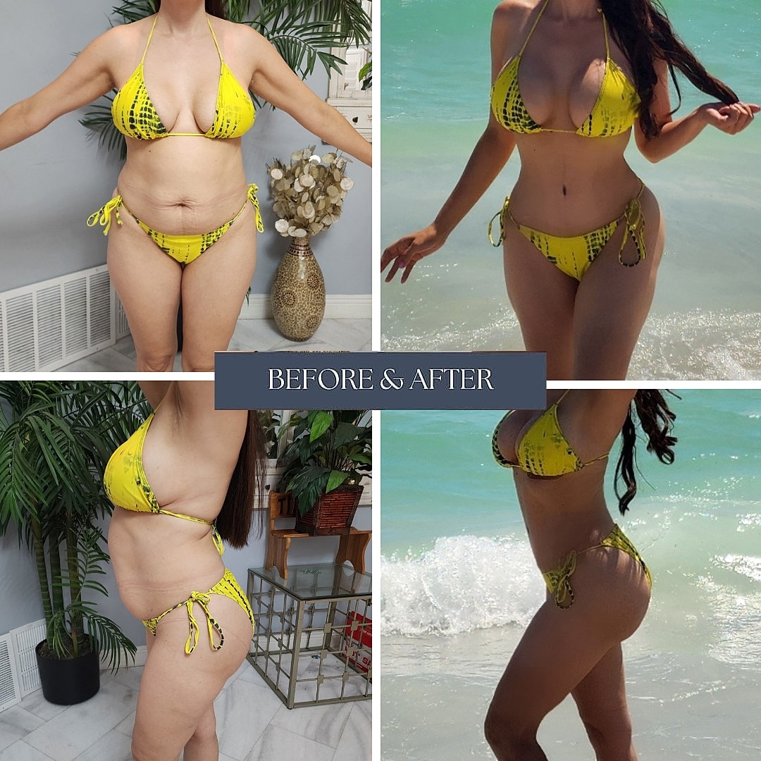Transformacion Mama Before & After