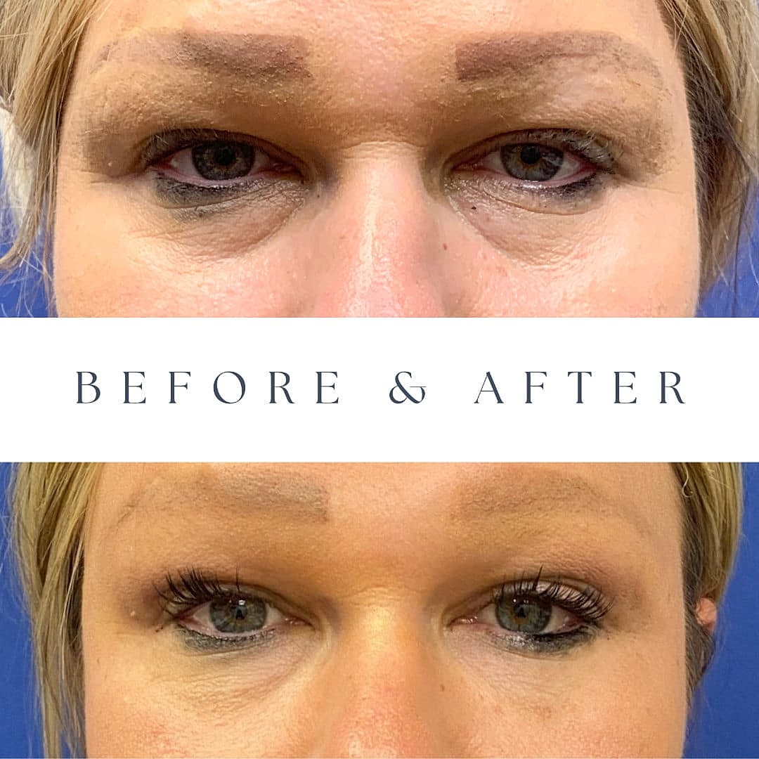 Fat Grafting Before & After