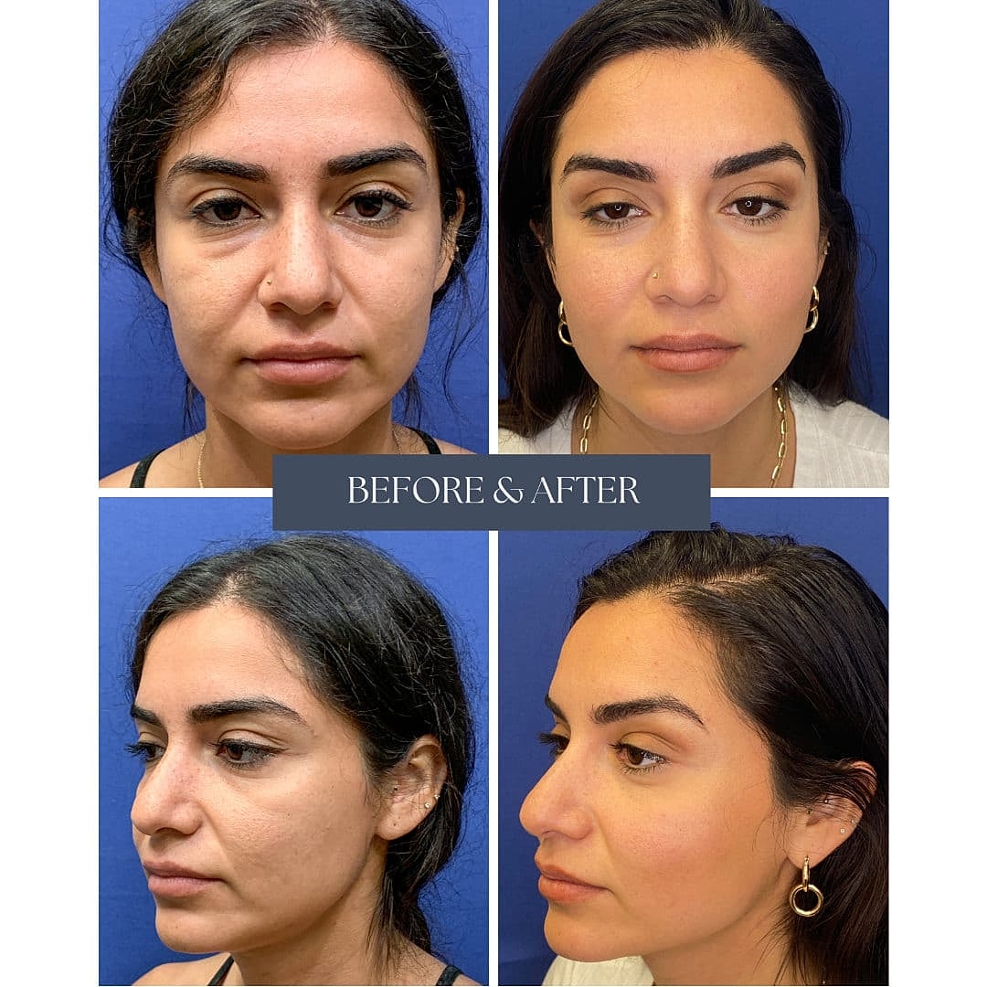 Fat Grafting Before & After