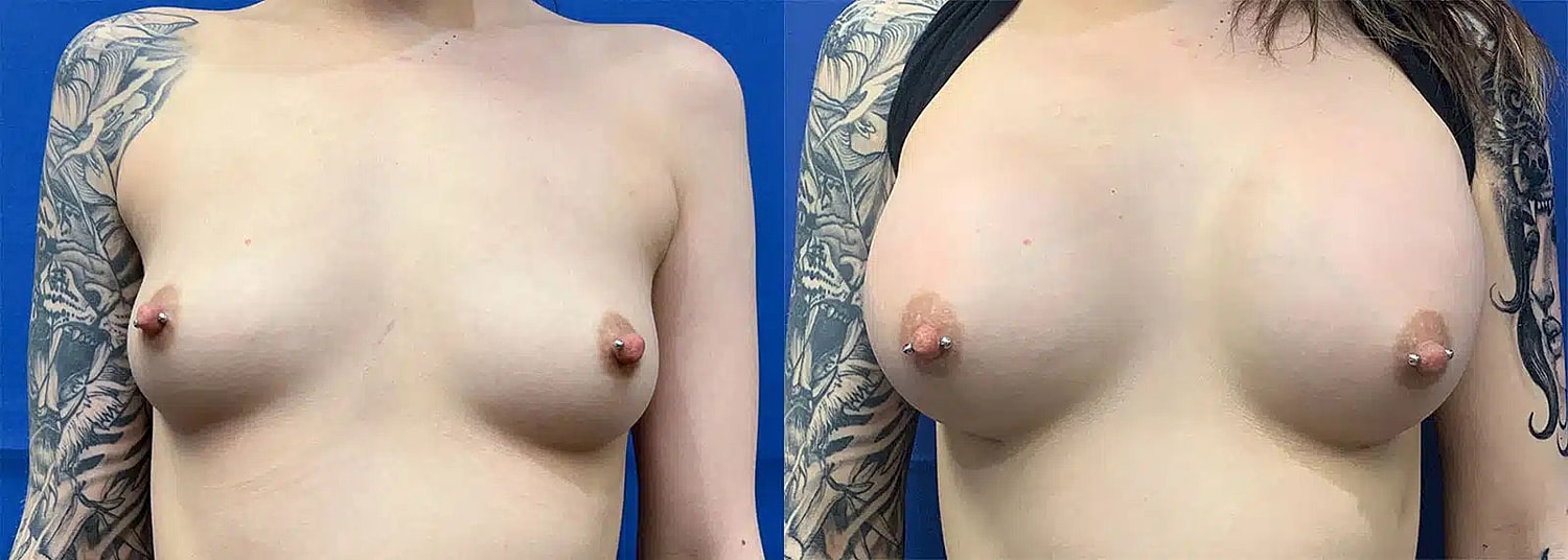 Aumento De Senos Before & After