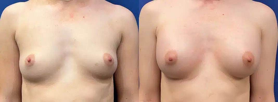 Aumento De Senos Before & After