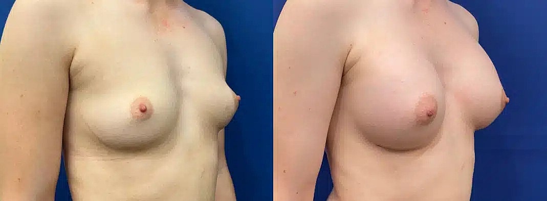 Aumento De Senos Before & After
