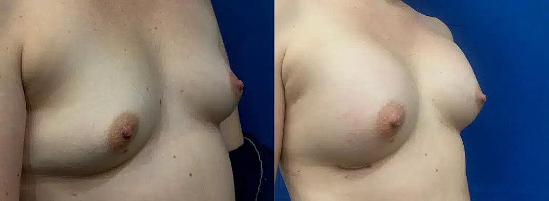 Aumento De Senos Before & After