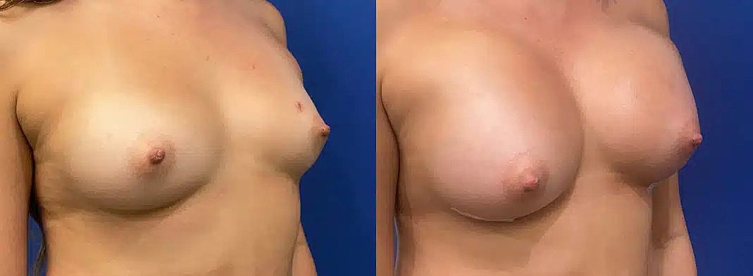 Aumento De Senos Before & After
